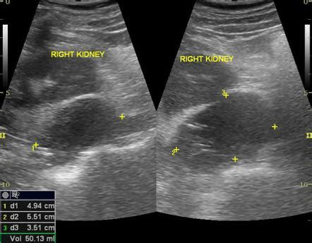 Perinephric abscess | Image | Radiopaedia.org