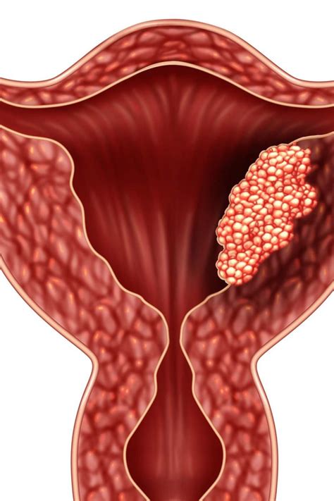 Endometrial cancer: Symptoms, staging, treatment, and causes