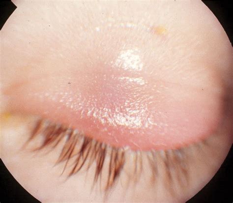 Lesson: Differentiating Problems of the Eyelids and Ocular Adnexa