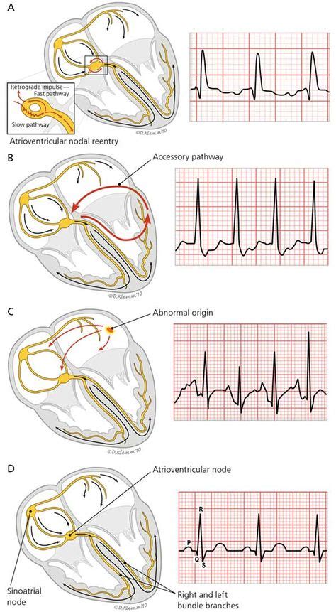 Diagnosis and Management of Common Types of Supraventricular ...