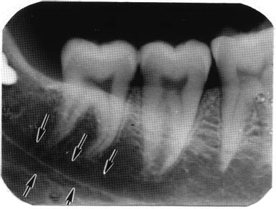 Mandibular Canal X Ray