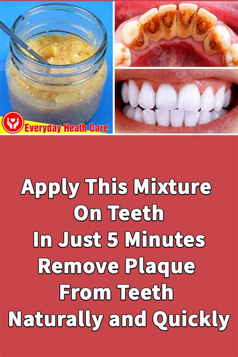 How to Remove Dental Plaque Naturally - Rijal's Blog