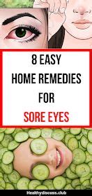 8 Easy home remedies for sore eyes | Sore eyes, Soreness remedies