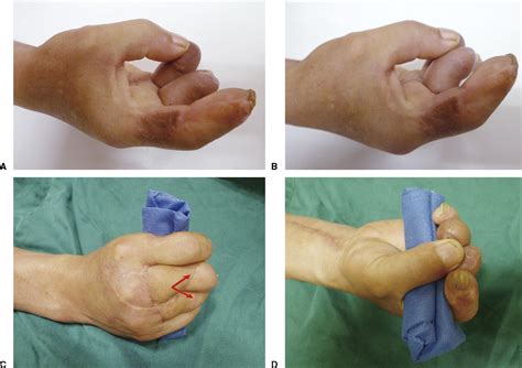 Reconstruction of Totally Degloved Fingers With a Spiraled ...