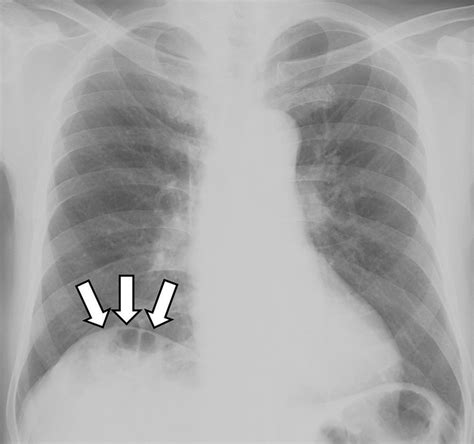 Gas under the right diaphragm | Cleveland Clinic Journal of Medicine