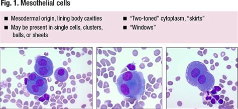 Fluid cytology—key features and ancillary testing - CAP TODAY