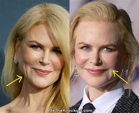 Nicole Kidman Plastic Surgery Comparison Photos