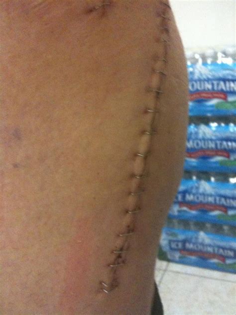 82 best Hip Replacement Scars images on Pinterest