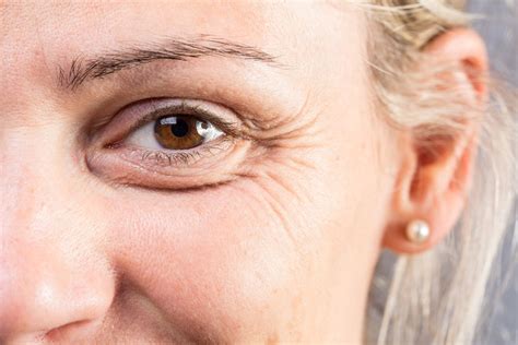 Understanding the Causes and the Best Treatment for Under-Eye Wrinkles