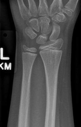 Normal AP wrist radiograph - pediatric | Radiology Case | Radiopaedia.org