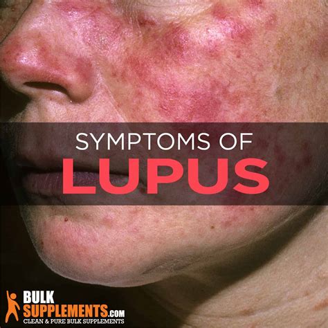 What is Lupus: Signs, Causes, Symptoms & Treatment