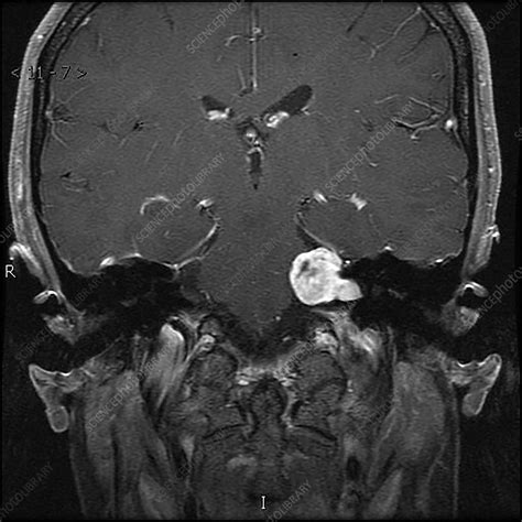 Vestibular Schwannoma, MRI - Stock Image - C039/4313 - Science Photo ...