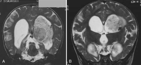 Choroid Plexus Tumors | Clinical Gate