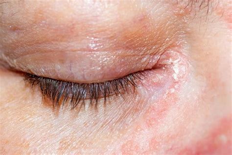 Atopic Dermatitis on the eyelids| Atopic skin | Eucerin