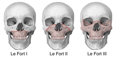 Dr. Lê Vũ Duy - Phân loại gãy Le Fort. * Gãy Le Fort I... | Facebook