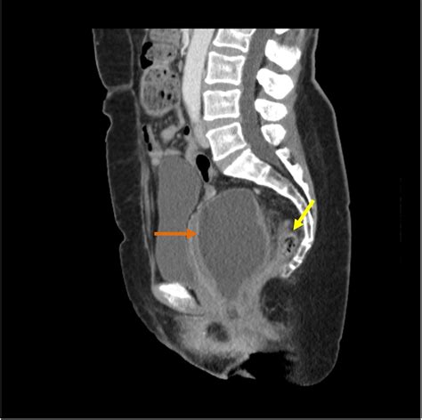 Perirectal Cyst