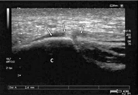 Ultrasound Images Of Plantar Fasciitis Ankle, Foot And Orthotic Centre ...