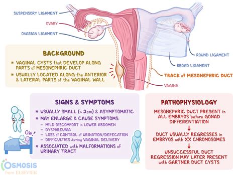 Gartner Duct Cyst: What Is It, Symptoms, and More | Osmosis