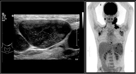 Lymphoma Neck Ultrasound