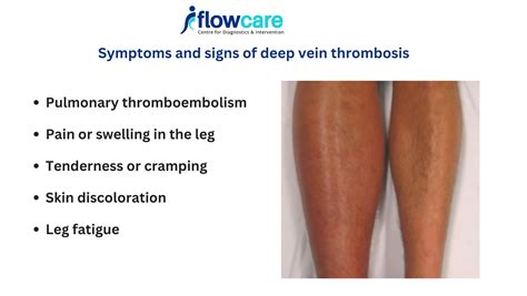 Prevention of DVT | DVT Precautions | Deep Vein Thrombosis Treatment