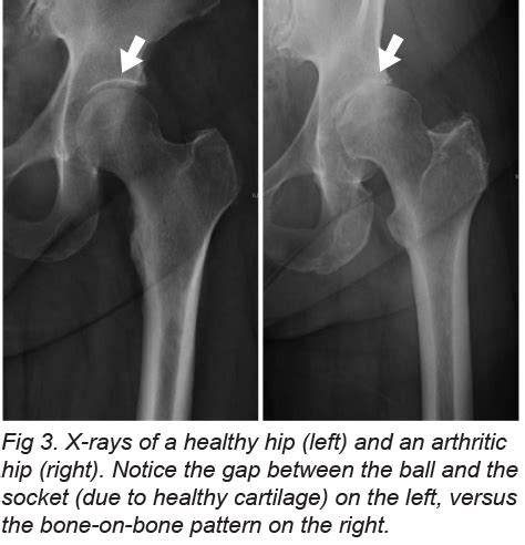 Arthritis of the Hip Joint - MU Health Care