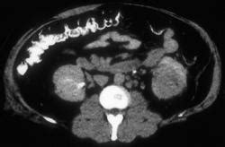 Renal Cell Carcinoma - Kidney Case Studies - CTisus CT Scanning