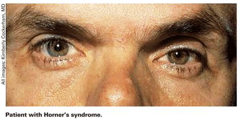 An Anatomic Approach to Unexplained Ocular Pain