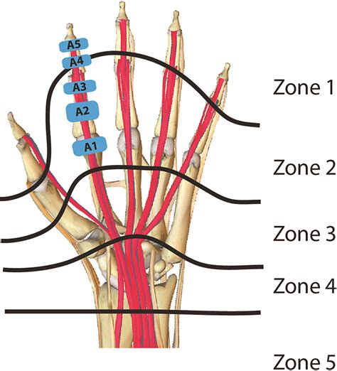 Flexor Tendon Zones Forearm