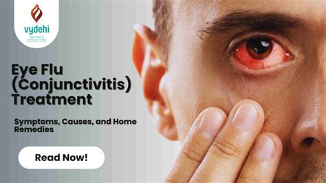 Eye Flu Treatment: Symptoms, Causes, and Home Remedies