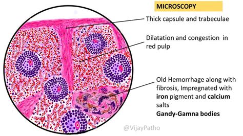 Chronic Venous Congestion : Spleen - Pathology Made Simple