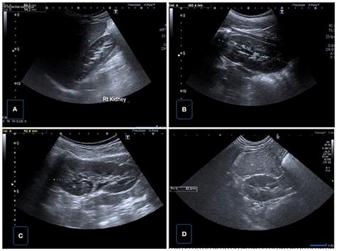 Kidney Stone Ultrasound