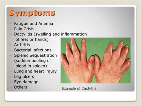 Sickle Cell Anemia Symptoms : Causes, Symptoms and Treatment of Sickle ...