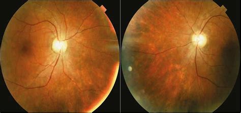 SciELO - Brasil - Acute Zonal Occult Outer Retinopathy (AZOOR) in a ...