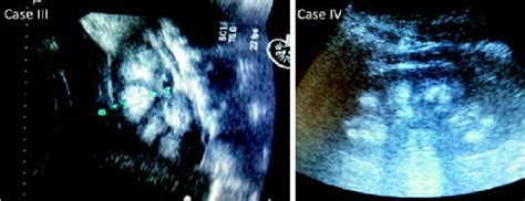 Medullary nephrocalcinosis at renal ultrasound. | Download Scientific ...