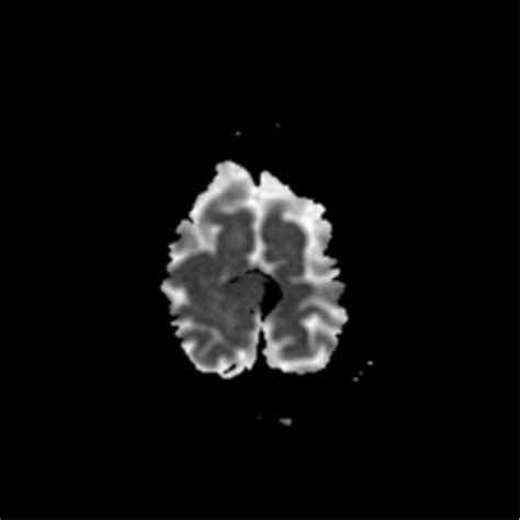 Falcine meningioma | Image | Radiopaedia.org