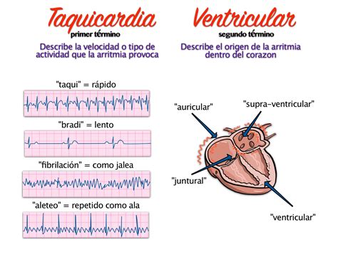 Arritmia, Ritmos Anormales en el Corazón - Doctablet®