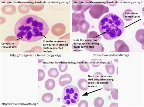 Haematology in a NutShell: Hypersegmented Neutrophils