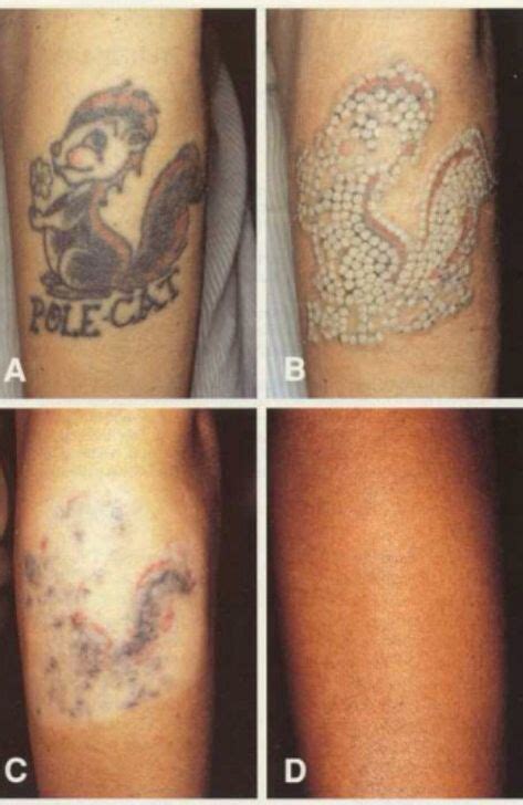 7 best Dermabrasion Tattoo Removal images on Pinterest | Laser tattoo ...