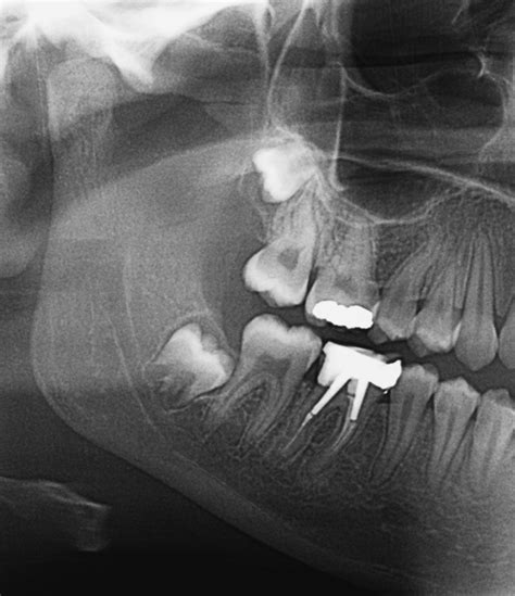 Toothache and Infection - Dental Disorders - MSD Manual Professional ...