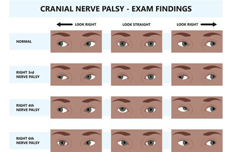 Cranial Nerve 3 Palsy