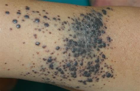 Cutaneous Metastases from Malignant Melanoma: Clinical Features and New ...