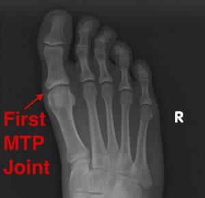 Great Mcp Joint Of Toe