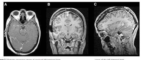 Figure 1 from Management of entrapped temporal horn by temporal horn to ...