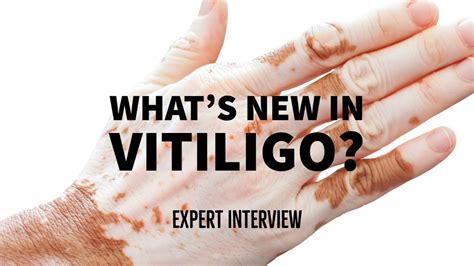 Vitiligo Treatment