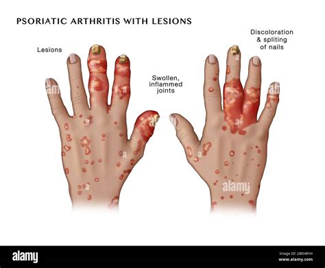 Psoriatic Arthritis with Lesions Stock Photo - Alamy