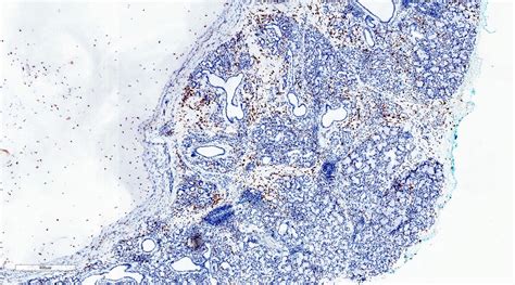 Mucocele Histology