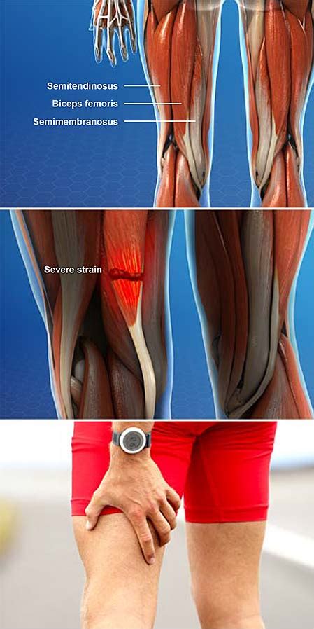 Hamstring Muscle Injuries | Central Coast Orthopedic Medical Group