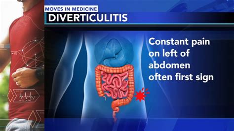 Diverticulitis: Indications and treatment method for the shockingly ...