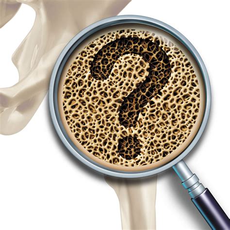 Should you be tested for weak bones? - Harvard Health