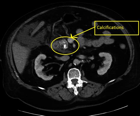 Hereditary pancreatitis CT scan - wikidoc